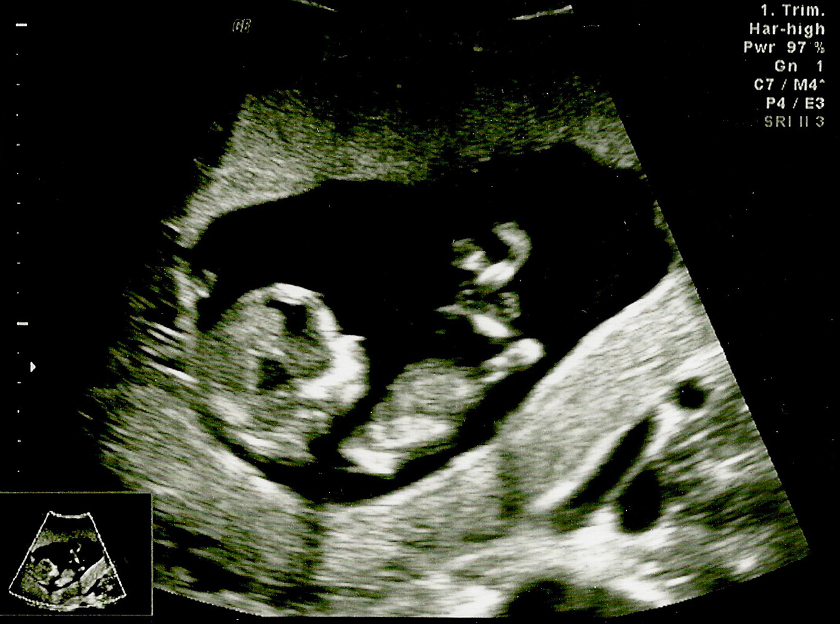 Baby 3 12 weeks ultrasound